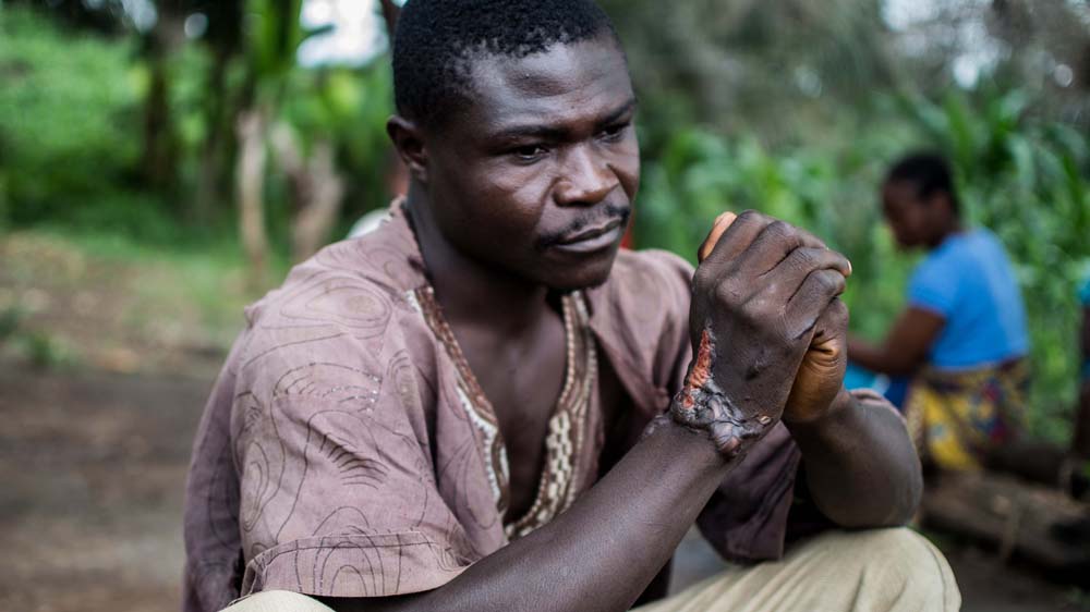 Emanuel attacked another villager during a mental breakdown and still suffers from the physical injuries he received when he was restrained during the episode[Olivia Acland/Al Jazeera]