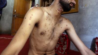 Pellet victims displaying their wounds in Srinagar