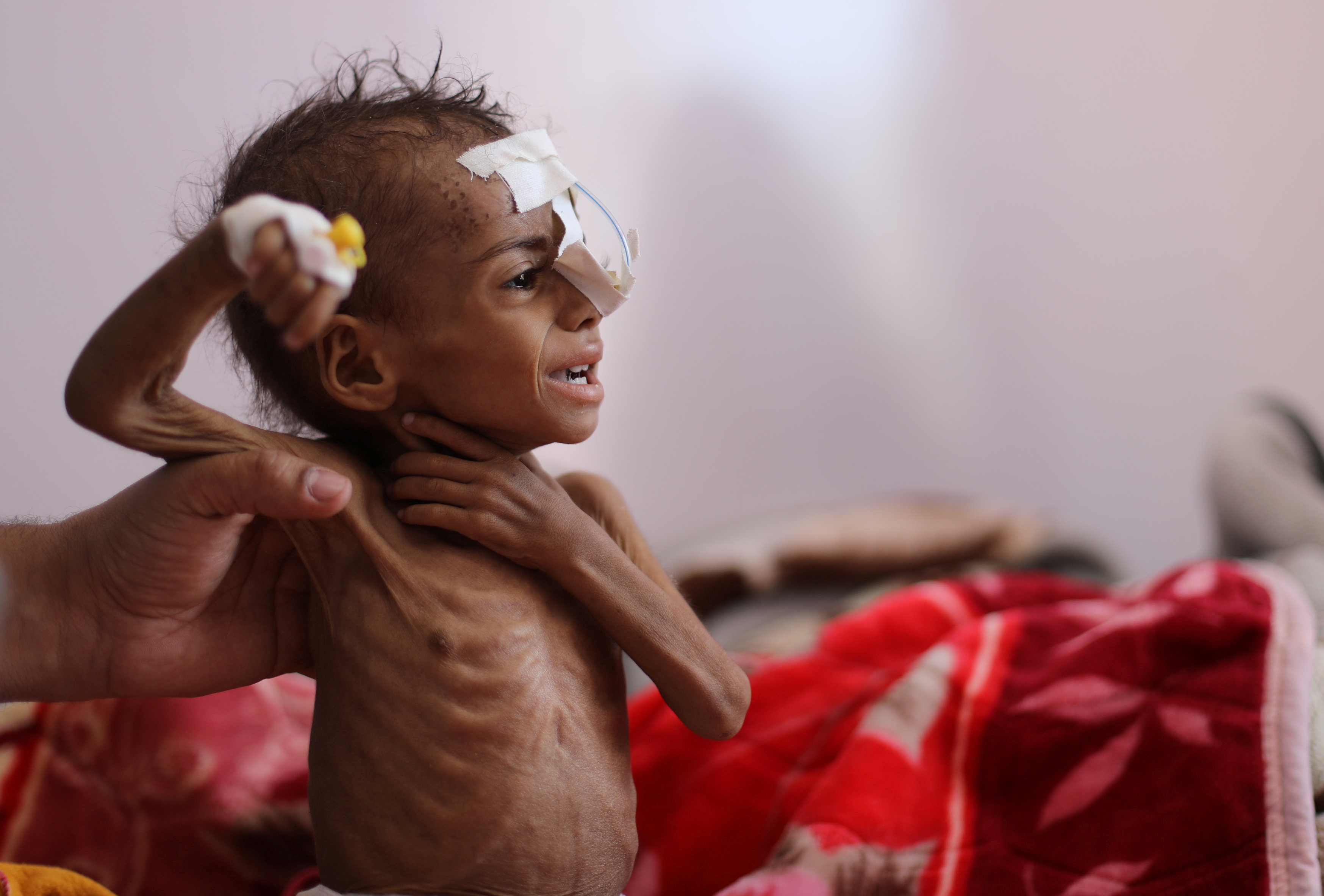 A nurse holds a malnourished girl at a treatment ward of al-Sabeen hospital in Sanaa