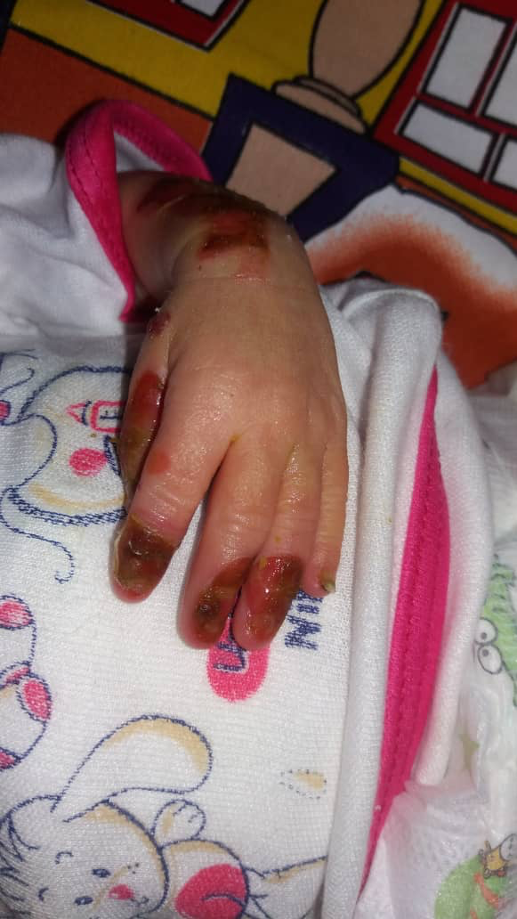 Sores are seen on the hand of baby Zeynab Mousavi, who suffered from epidermolysis bullosa [Courtesy: Ahmad Mousavi]