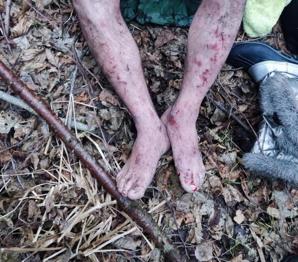 A man bears the marks of a violent beating he received from Belarusian border guards after he was pushed back from Poland [Courtesy: Gandhi Charity]