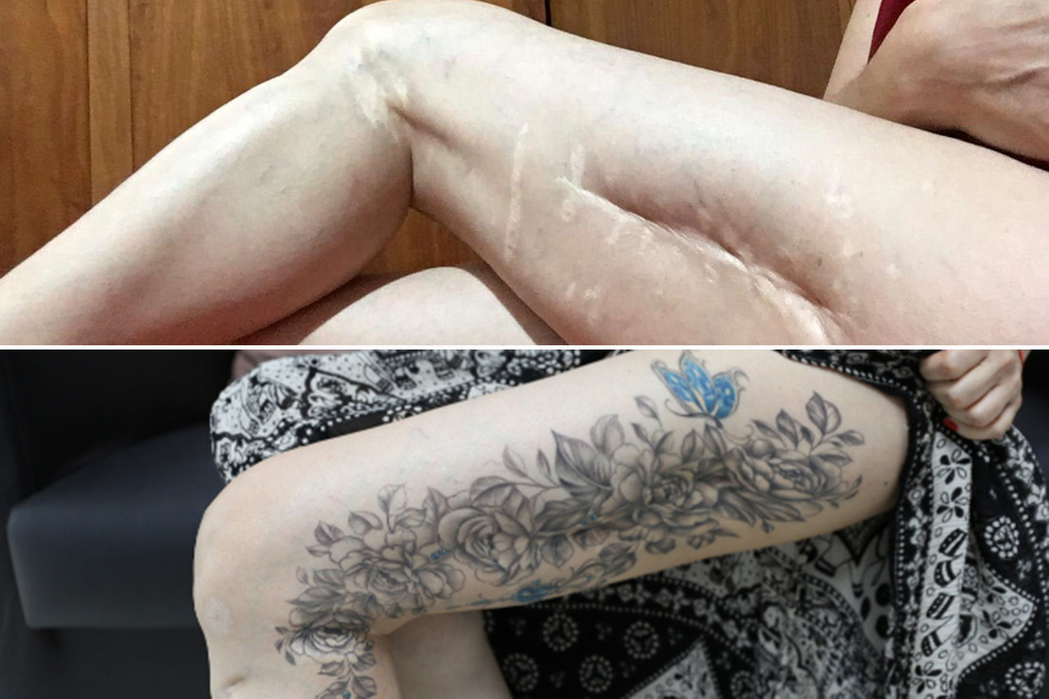 Mendes’s work covering up scars from a traffic accident