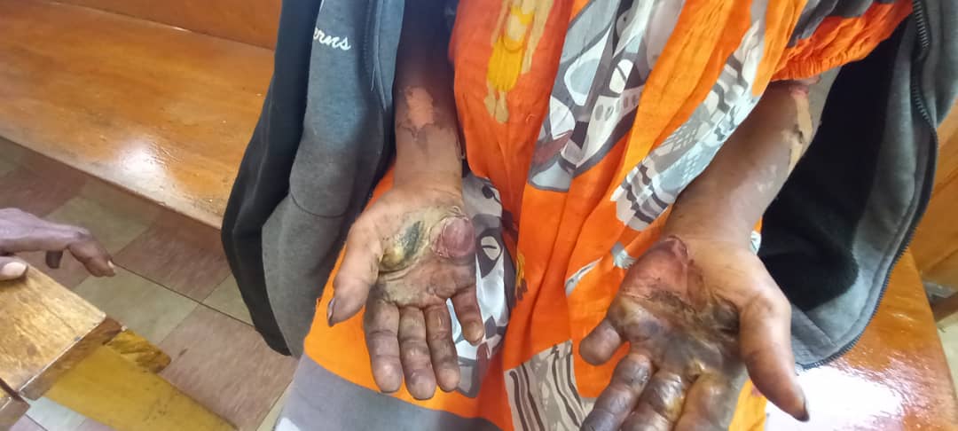 A woman shows her burned and bloody hands after she was tortured and accused of sorcery in July.