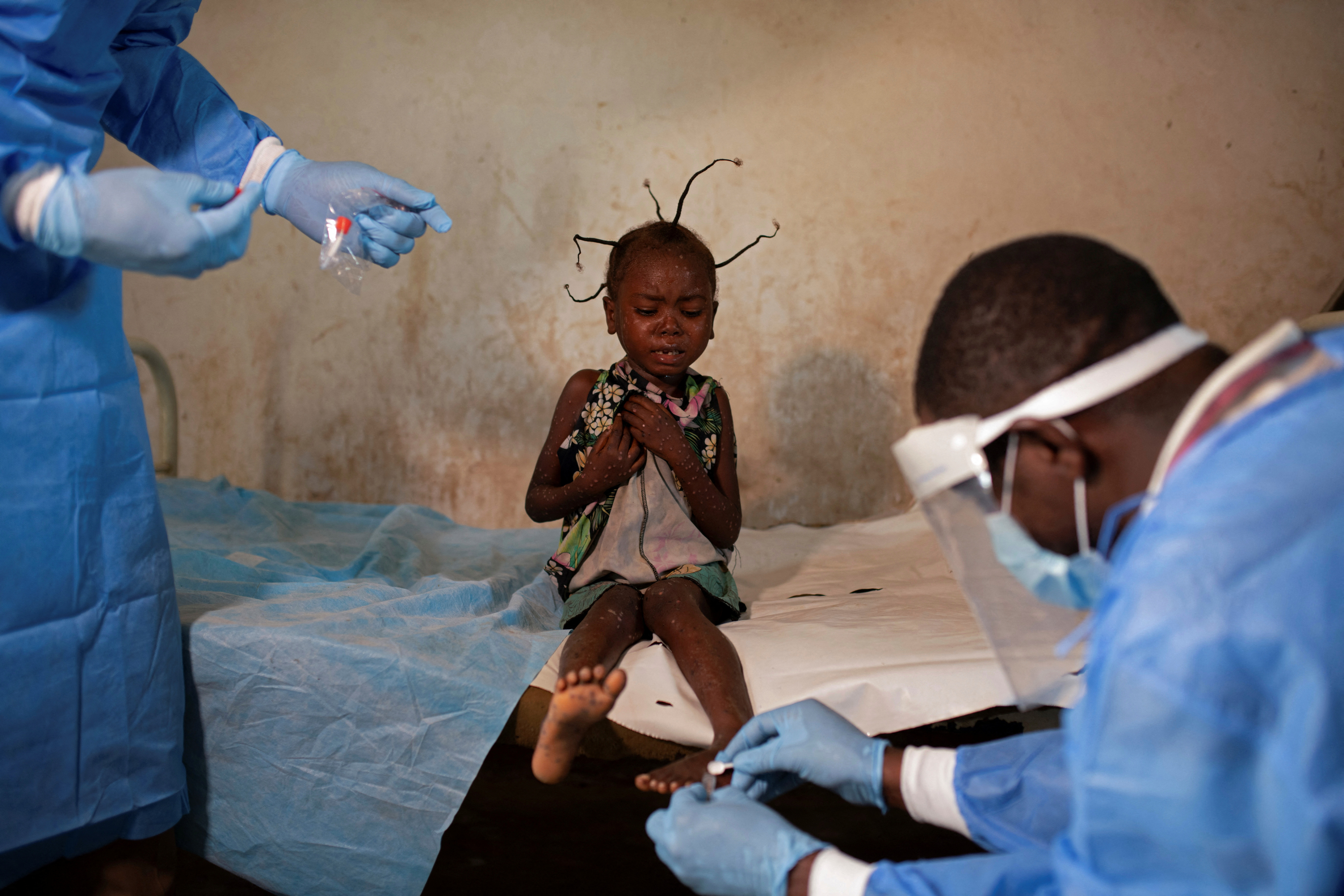 HEALTH-MONKEYPOX/AFRICA