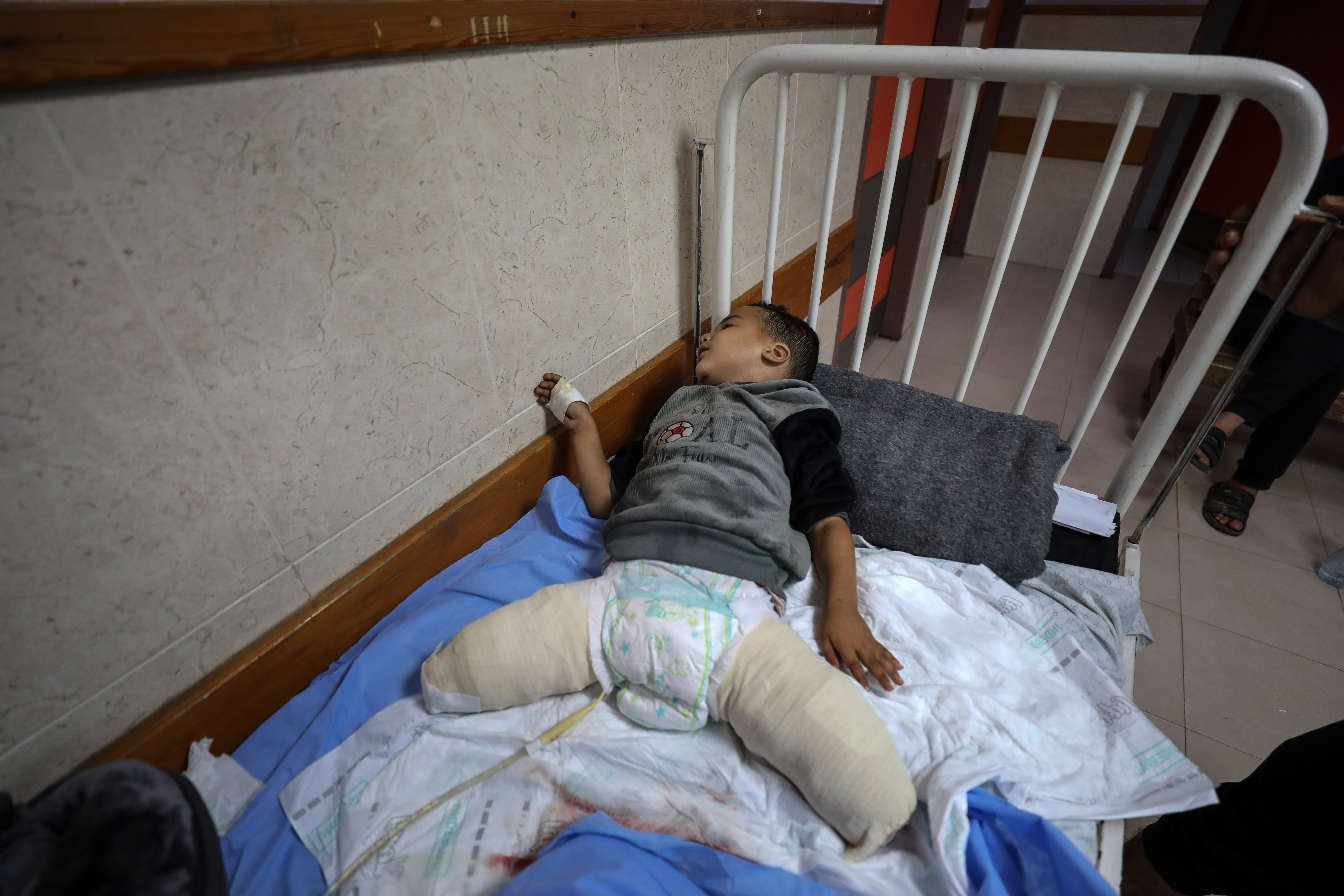 Ahmad Shabat, age three, spent three hours on the operating table