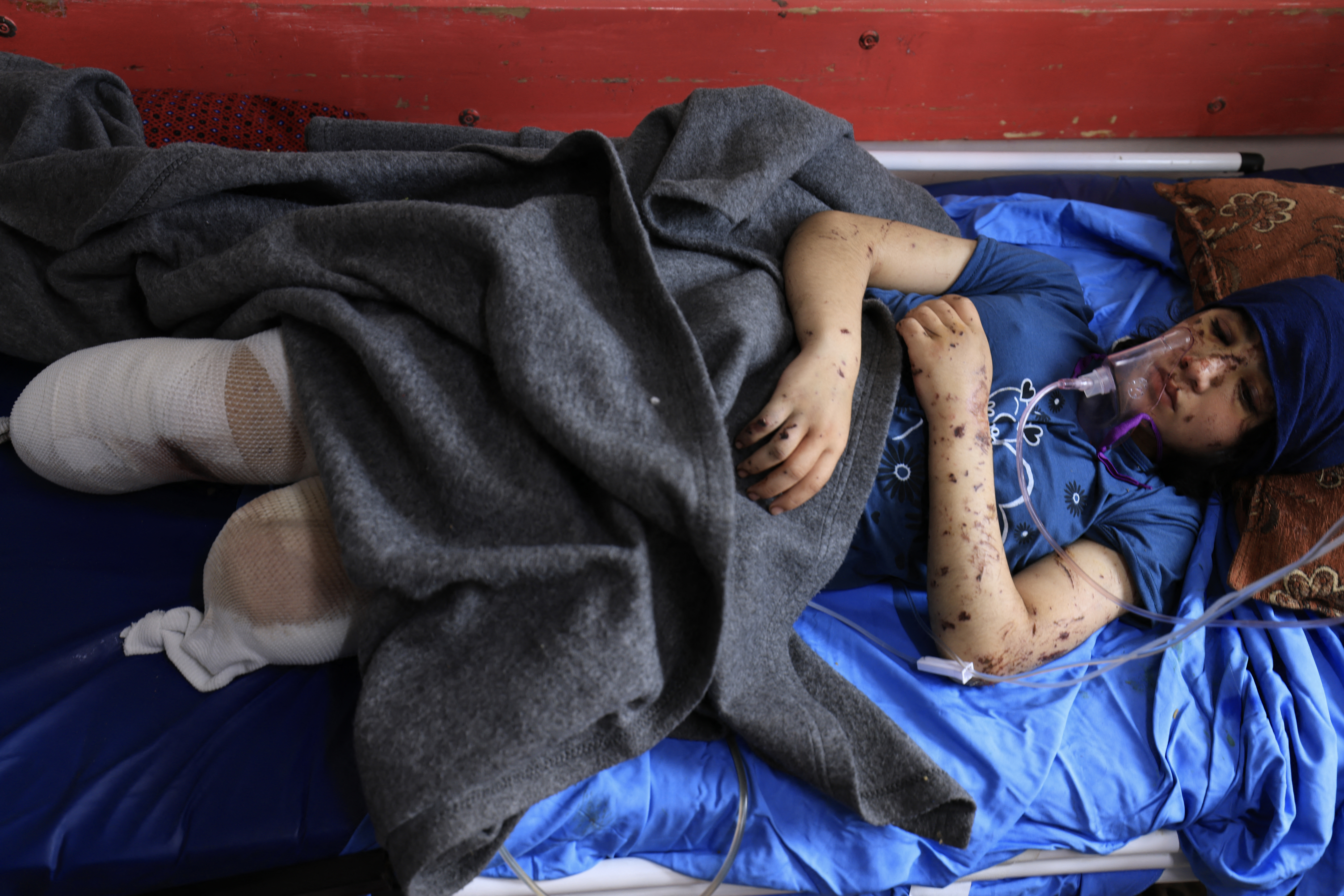 Thirteen year-old amputee Layan al-Baz receives treatment at the Nasser hospital in Khan Yunis in the southern Gaza Strip.
