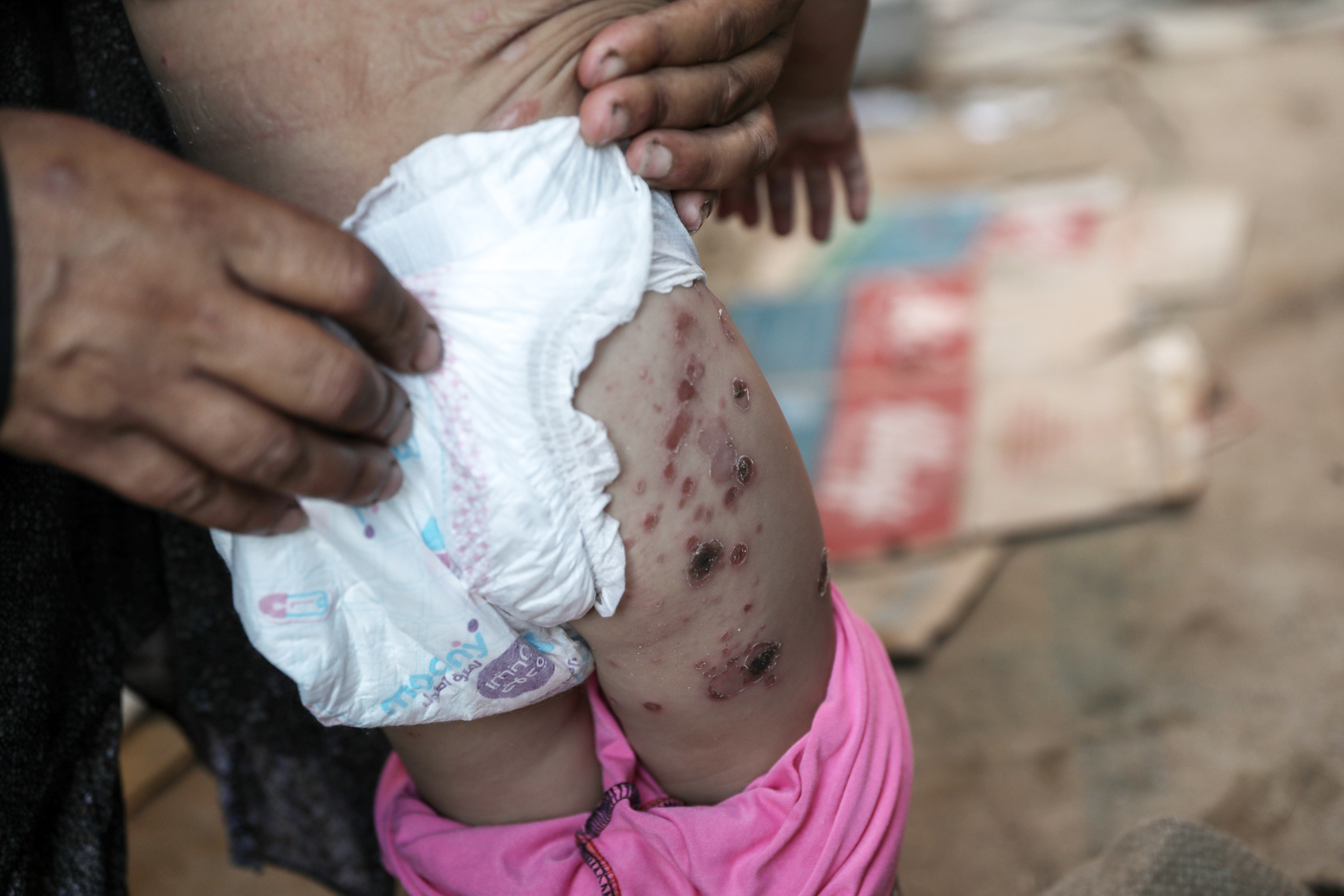 Nahla’s one-year-old daughter suffers from a bacterial skin rash