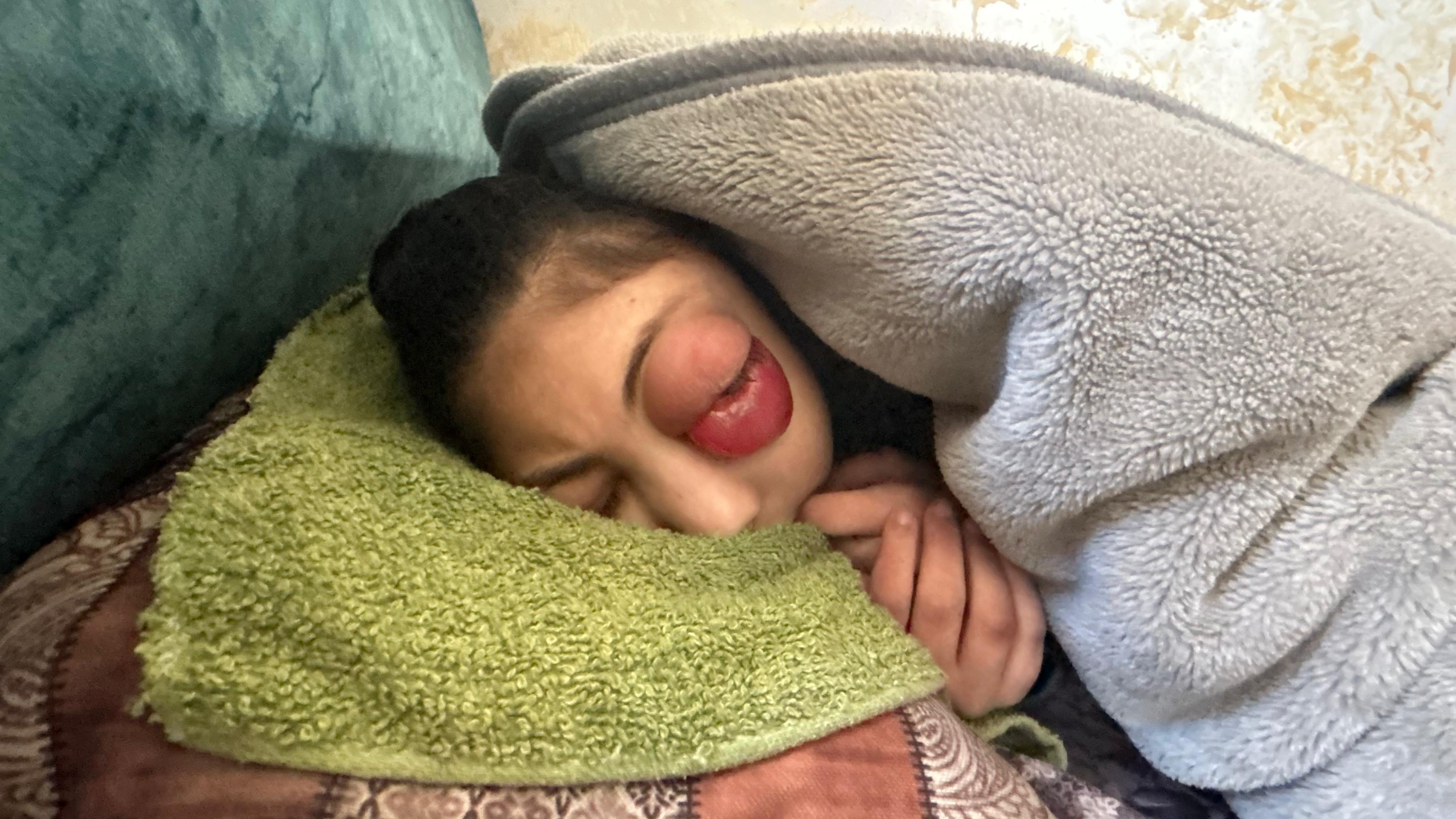 Girl lies covered with a blanket, with a large red tumour on one of her eyes