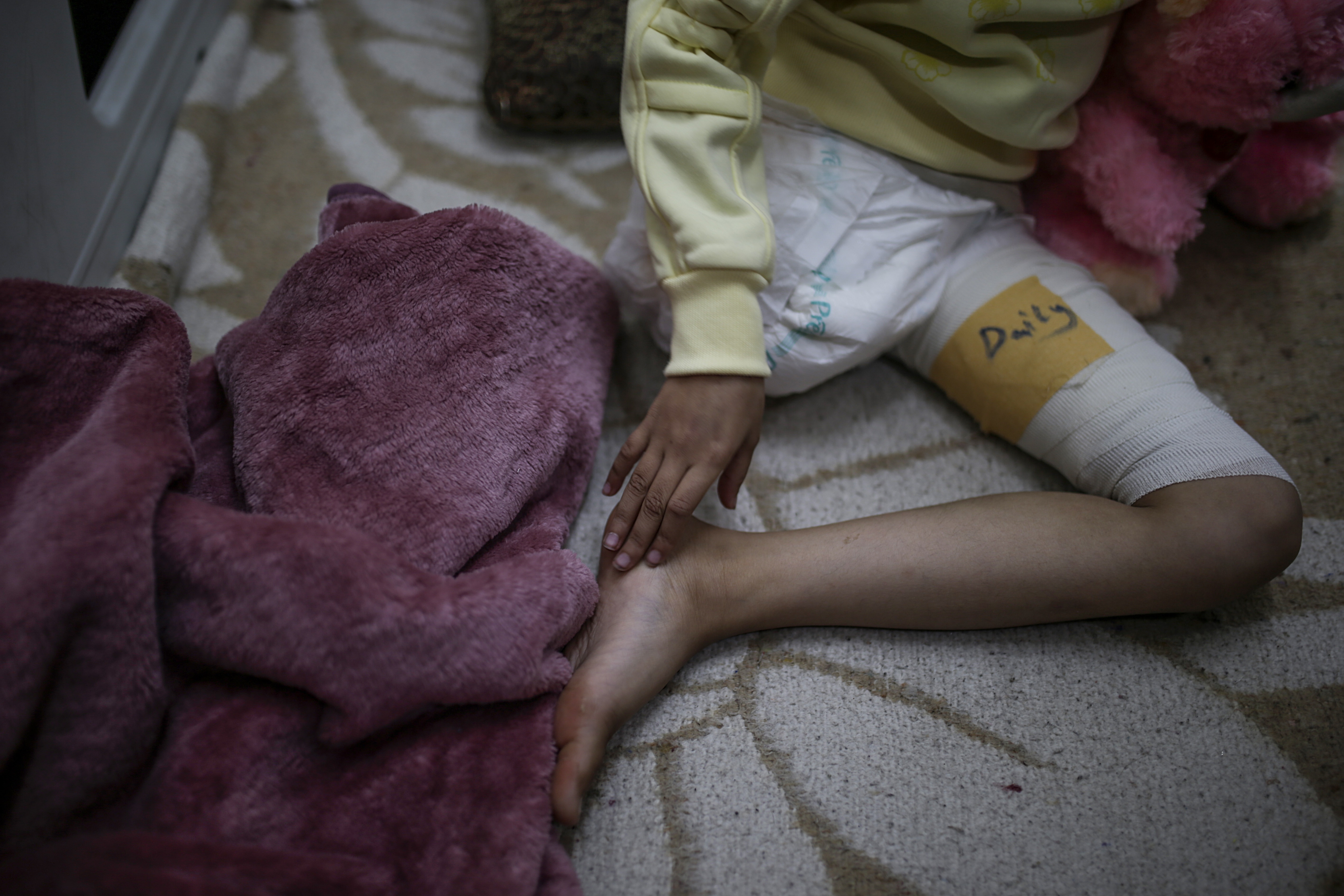 epa11793286 Nine-year-old internally displaced Palestinian girl Heba Muhanna, who had her right leg amputated, sits on a bed at the Al Aqsa martyrs hospital in Deir al Balah, central Gaza Strip, 24 December 2024 (issued 25 December 2024). Heba fled with her family from the northern Gaza Strip to the south after October 2023. Following Israeli airstrikes on the Al Nusairat refugee camp on 12 December 2024, Heba lost her father as well as five uncles, and had her leg amputated. According to a December 2024 report by the UN Palestine refugee agency UNRWA, Gaza currently has the highest number of child amputees per capita anywhere in the world.