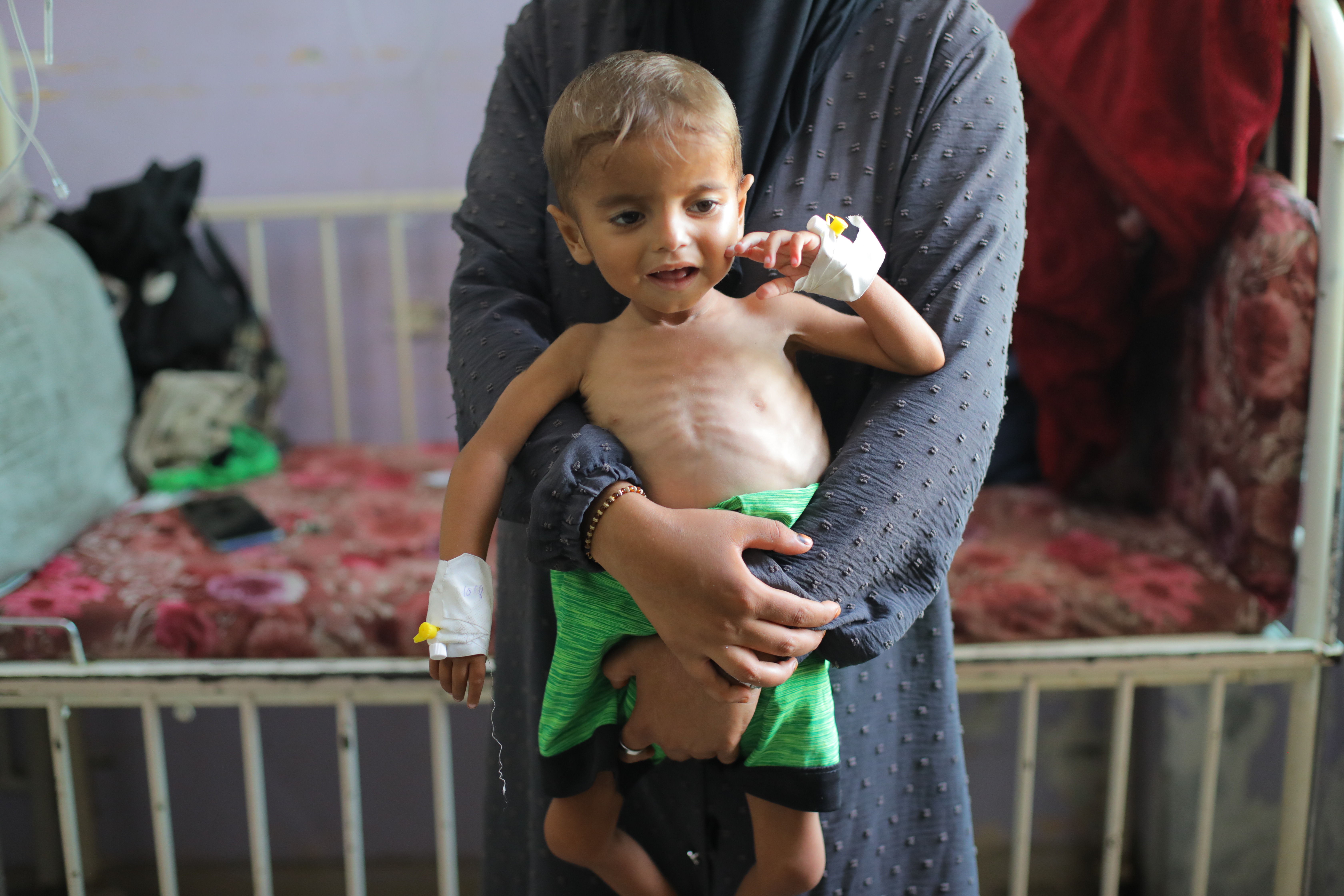 Malnourished Gaza children treated with limited medical resources