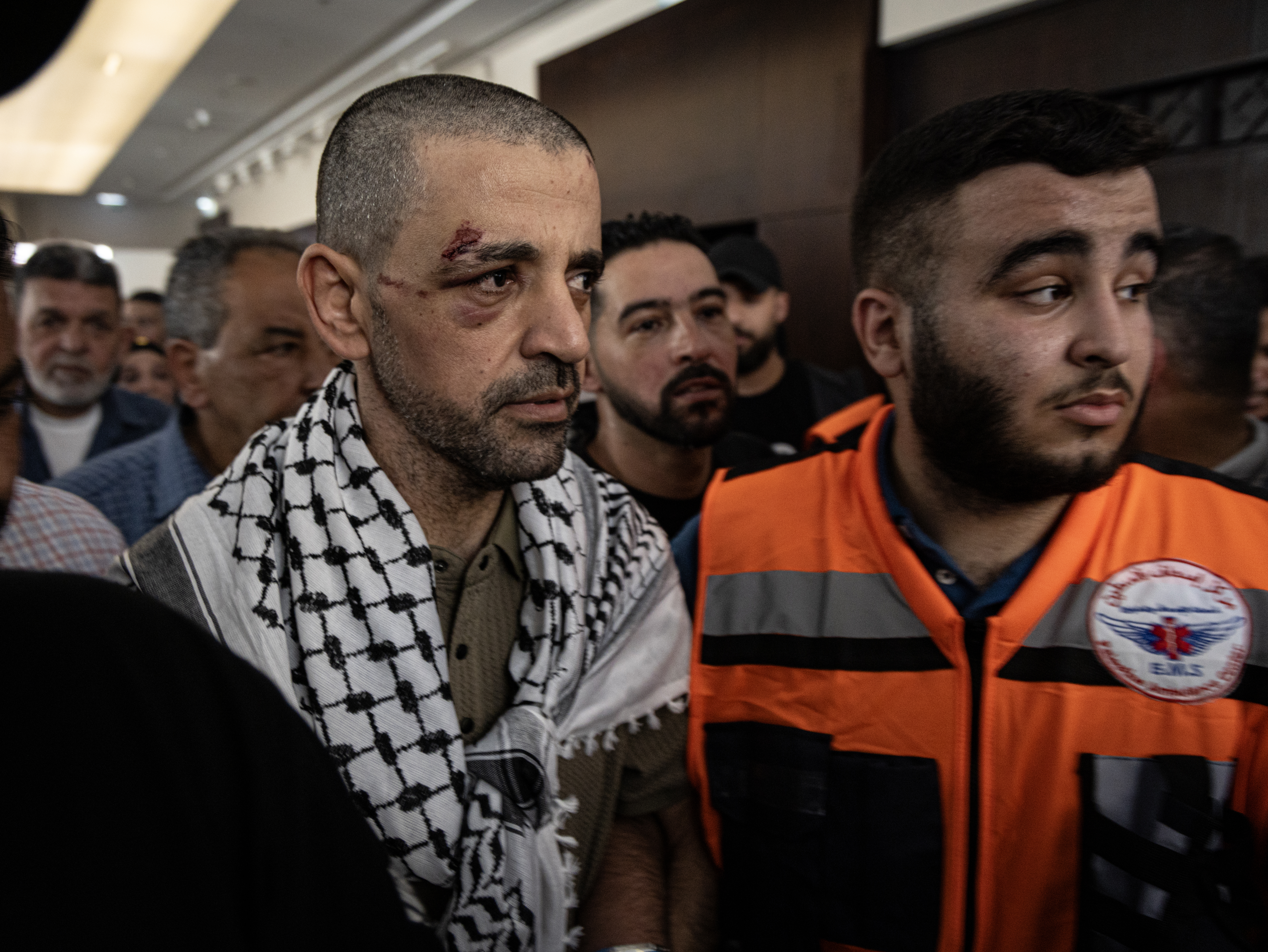 A facial injury is visible on a Palestinian prisoner during the families' reception of the released detainees from Israeli jails on October 13, 2025 in Ramallah, West Bank. (Faiz Abu Rmeleh/Getty Images)