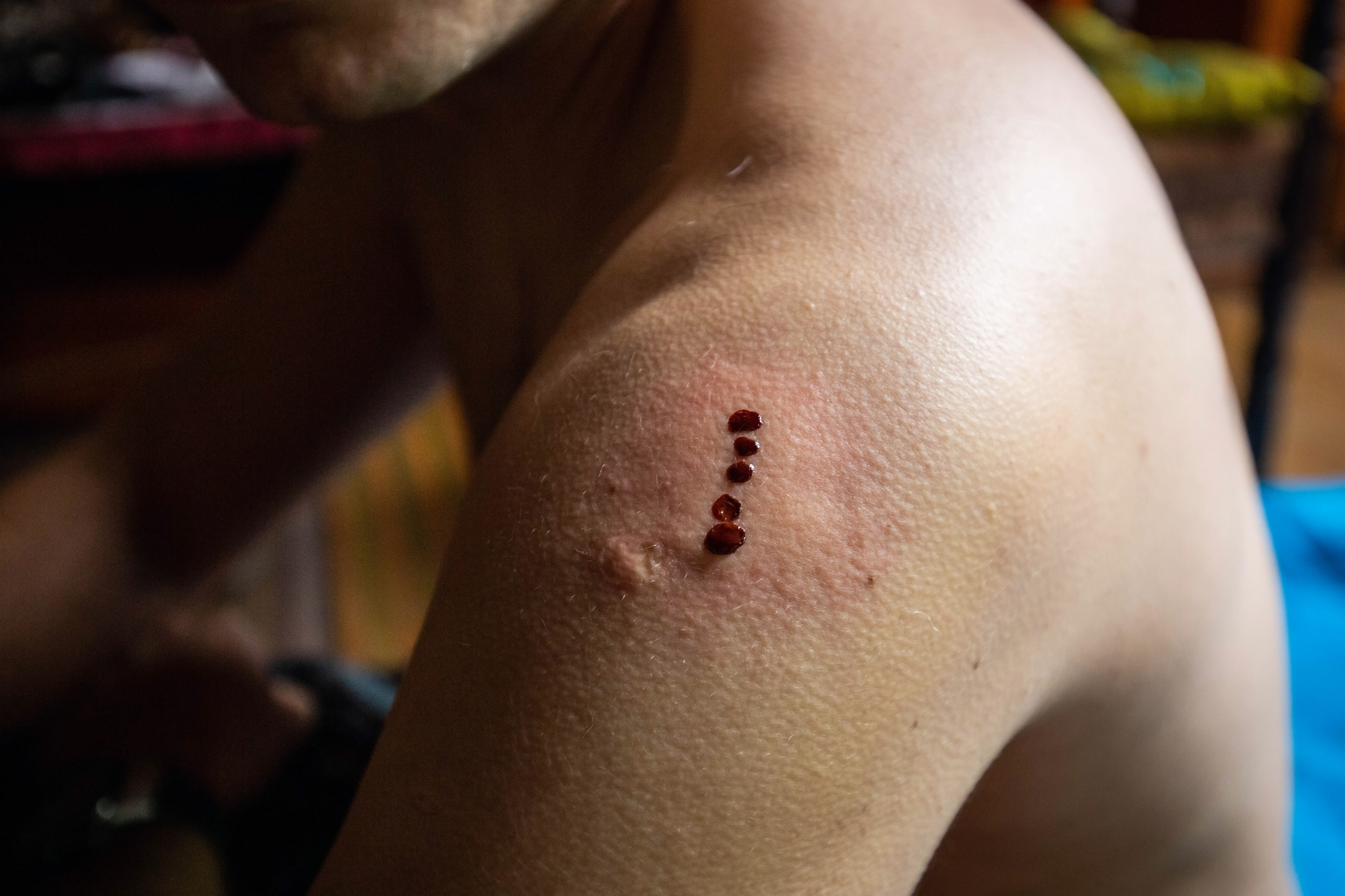 Frog poison is dabbed onto superficial burns on the skin in the kambo ritual [Shutterstock]
