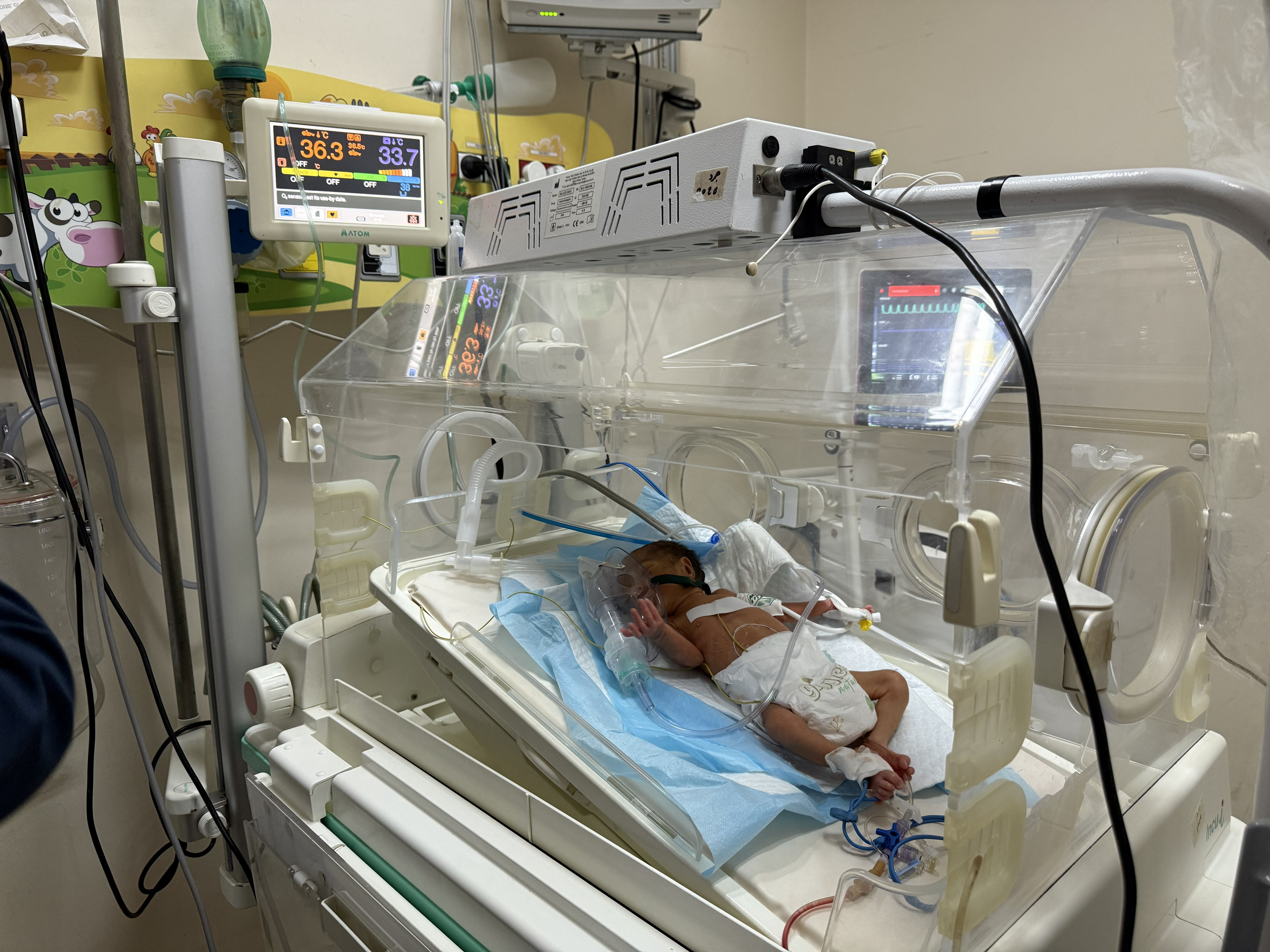 Yazan Al-Khalidi, born in the eighth month of pregnancy. After birth, he experienced breathing difficulties. [Eman Abu Zayed/Al Jazeera]